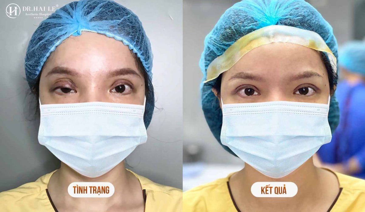 Chuyên gia sửa mí mắt Dr.Hải Lê? 8 Khách hàng sửa mí thành công tại Dr.Hải Lê