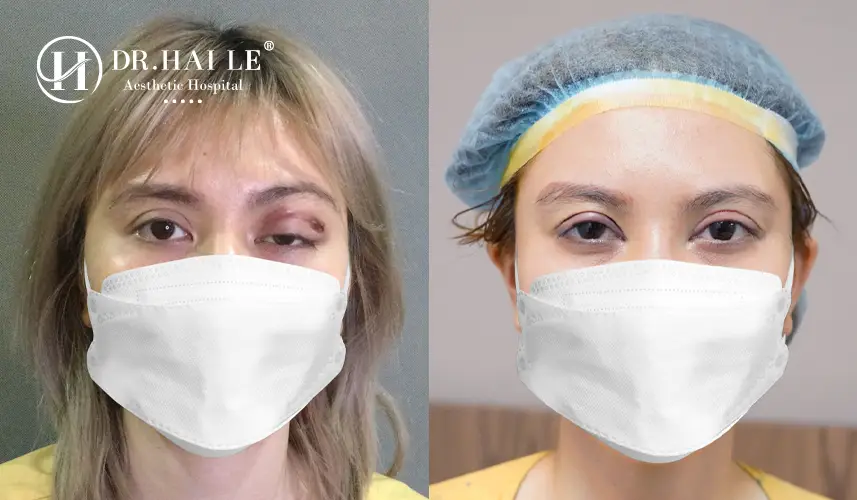 Kết quả sửa mí tại Bệnh viện Tạo hình Thẩm mỹ Dr.Hải Lê