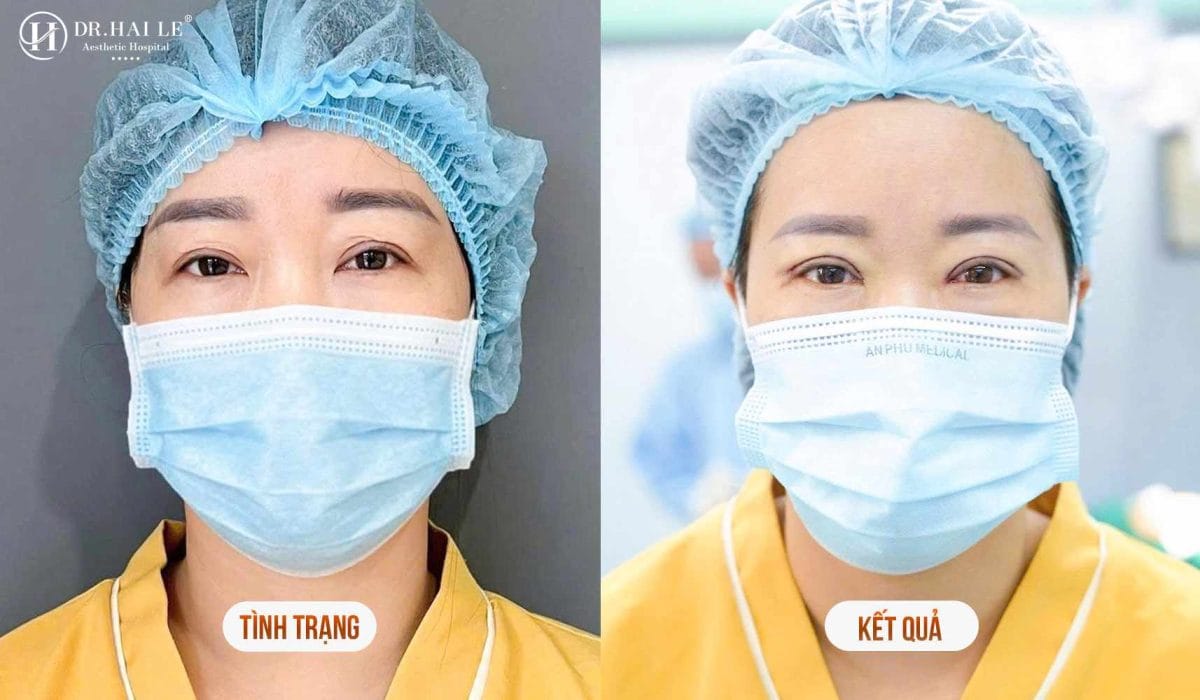 Chuyên gia sửa mí mắt Dr.Hải Lê? 7 Kết quả sửa mí mắt tại Dr.Hải Lê
