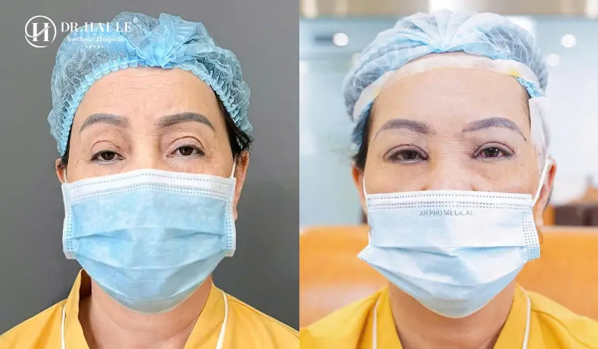Kết quả sửa mí mắt hỏng thành công tại Dr.Hải Lê