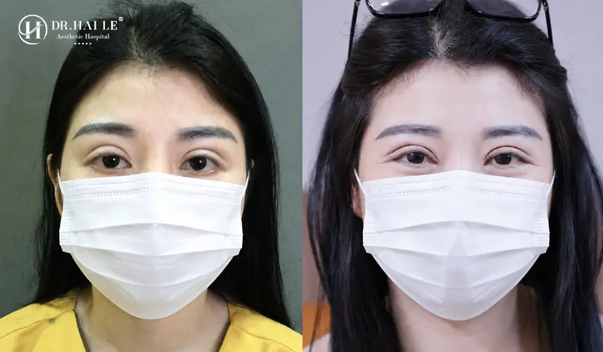Hình ảnh khách hàng sau sửa mí hỏng