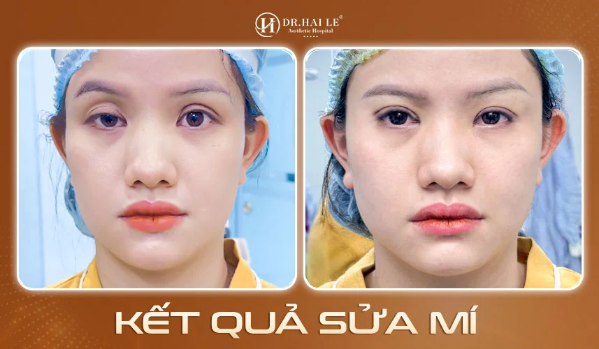 Kết quả sửa mí tại Bệnh viện Tạo hình Thẩm mỹ Dr.Hải Lê 2