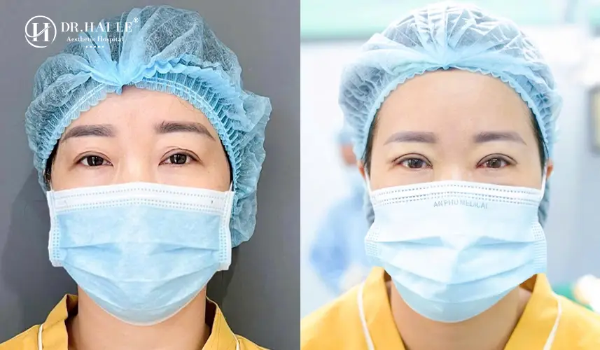 Kết quả phục hồi đôi mắt sau sửa mí tại Dr.Hải Lê