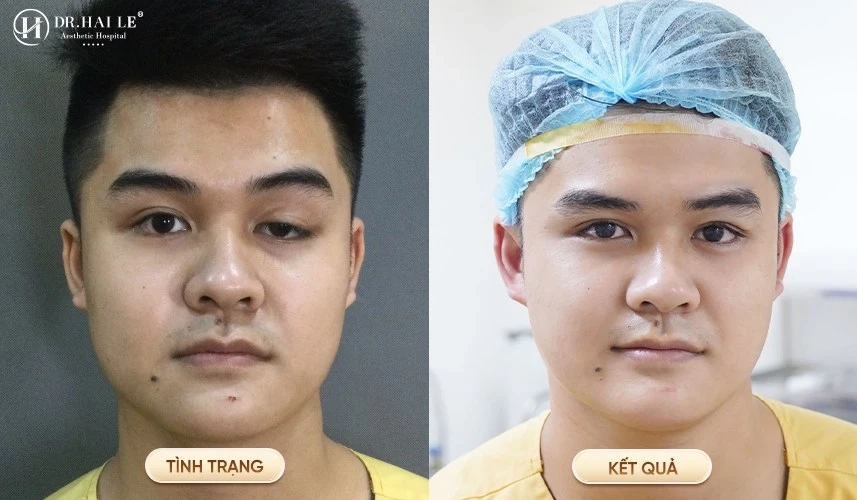 Kết quả thực tế sau khi phẫu thuật sửa mí hỏng tại Dr.Hải Lê