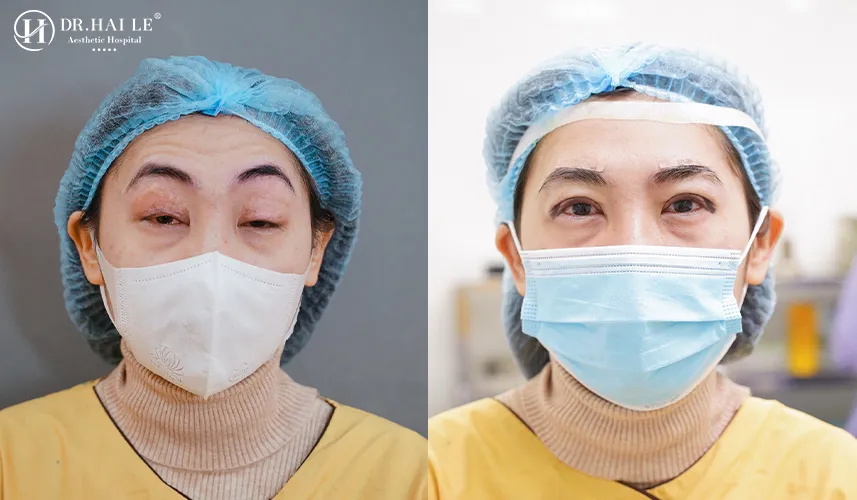 Kết quả sửa mí mắt Dr Hải Lê