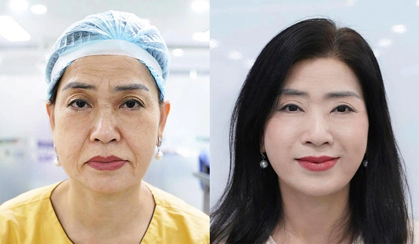 Dịch vụ căng da mặt chuẩn y khoa hướng đến sự an toàn, hài hòa, tự nhiên