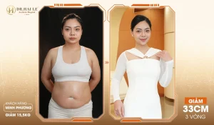 Lipomed giảm mỡ đạt hiệu quả 3 vòng cho khách hàng