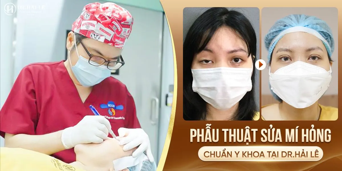 Phẫu thuật sửa mí hỏng tại Dr.Hải Lê?