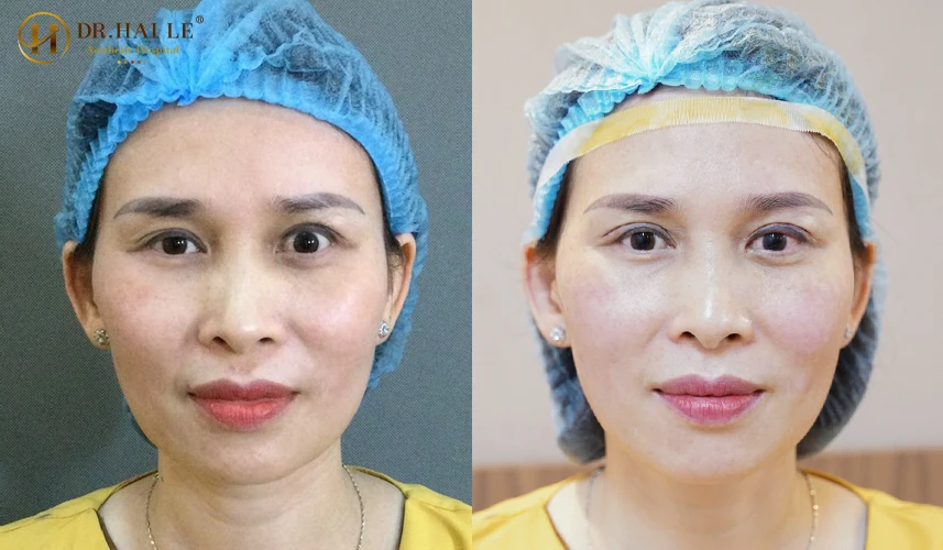 Mí mắt bị trợn là hiện tượng bờ mi trên hoặc mi dưới bị co kéo lệch khỏi vị trí giải phẫu sinh lý, khiến diện tích lòng trắng
