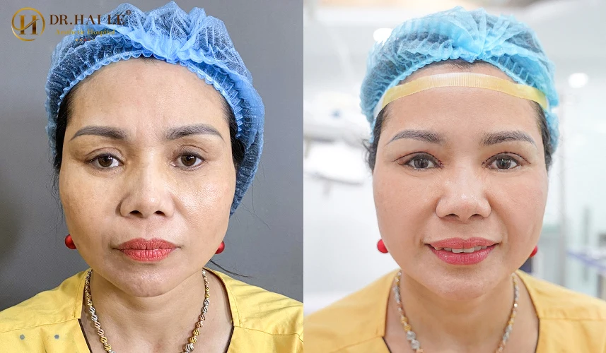 Để giải cứu những ca mí hỏng nặng nề, Bệnh viện Thẩm mỹ Dr.Hải Lê đã nghiên cứu và ứng dụng thành công kỹ thuật độc quyền Deep Tech 20