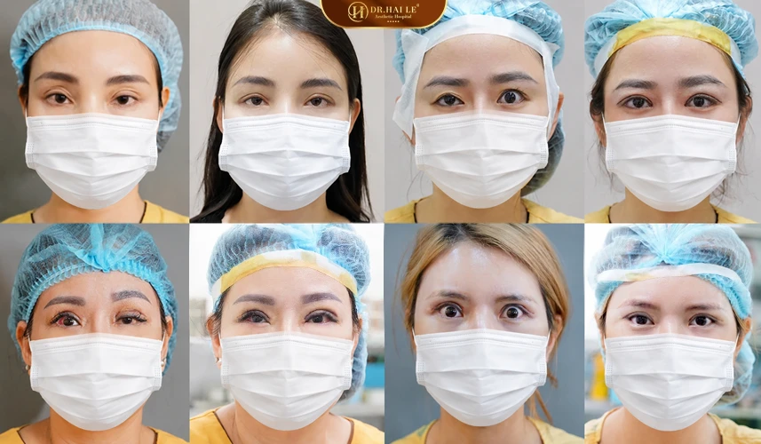 Những trường hợp cắt mí hỏng thường gặp