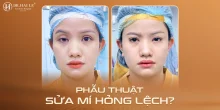 Phẫu thuật sửa mí hỏng lệch? Bệnh viện thẩm mỹ Dr.Hải Lê