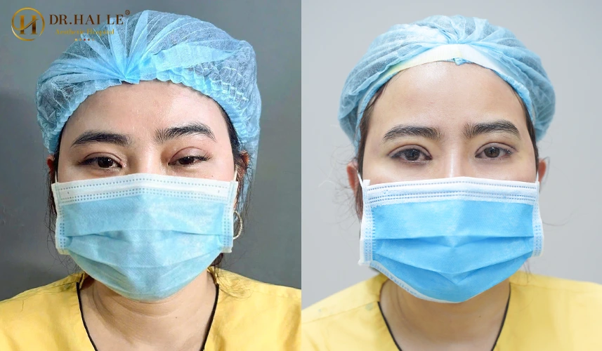 Phẫu thuật sửa mí hỏng lệch là kỹ thuật tái tạo vi phẫu chuyên sâu nhằm giải phóng hoàn toàn các dải sẹo xơ dính