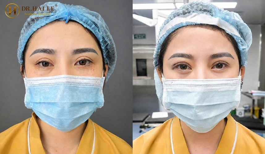 Sửa mí hỏng lệch mỗi tình trạng biến chứng sau cắt mí đều mang những đặc thù tổn thương mô học riêng biệt