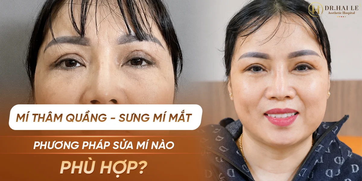 Phương pháp sửa mí mắt bị thâm quầng và sưng mí mắt?