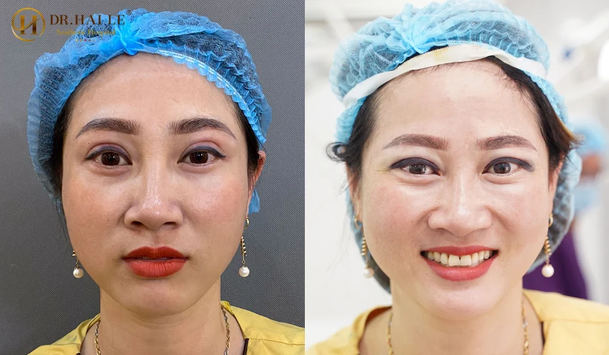 Sửa mí mắt bị thâm quầng và sưng mí mắt là kỹ thuật can thiệp vi phẫu y khoa nhằm điều chỉnh cấu trúc mô mềm
