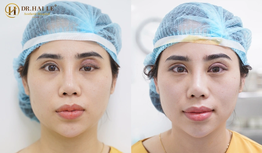 Tại Dr.Hải Lê, mọi ca sửa mí mắt bị thâm quầng và sưng mí mắt đều được thực hiện trong môi trường vô khuẩn