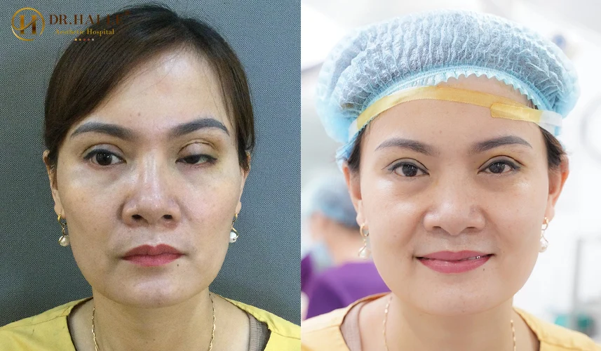 Bệnh viện Tạo hình Thẩm mỹ Dr.Hải Lê cam kết mang đến giải pháp sửa mí mắt bị thâm quầng và sưng mí mắt chuẩn y khoa