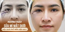 Phương pháp sửa mí mắt dưới hiệu quả phổ biến hiện nay?