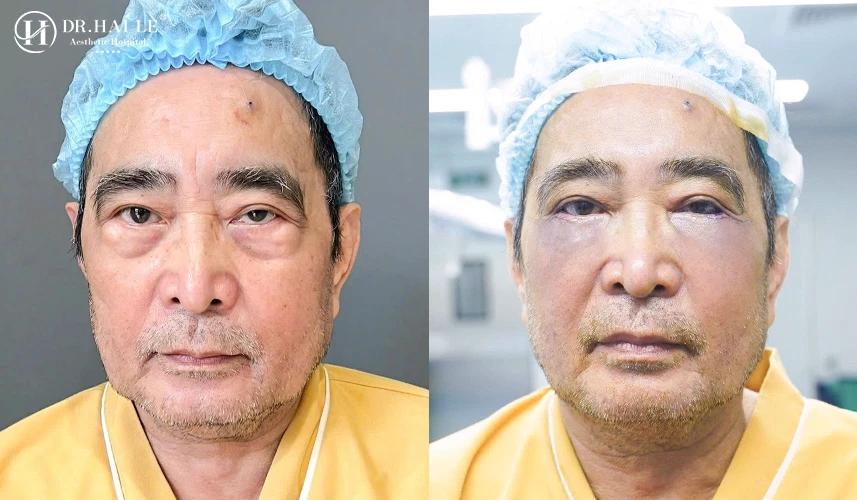 Về mặt y khoa, vùng mi mắt dưới có cấu trúc giải phẫu cực kỳ mỏng manh với sự đan xen của cơ vòng mi