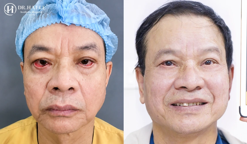 Sửa mí mắt dưới đều được thực hiện theo quy trình 6 bước khép kín, đảm bảo tiêu chuẩn "Vô khuẩn tuyệt đối"