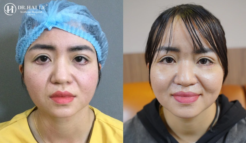 Sửa mí mắt dưới tại đây không chỉ là một thủ thuật thẩm mỹ, mà là sự hồi sinh cho đôi mắt của bạn