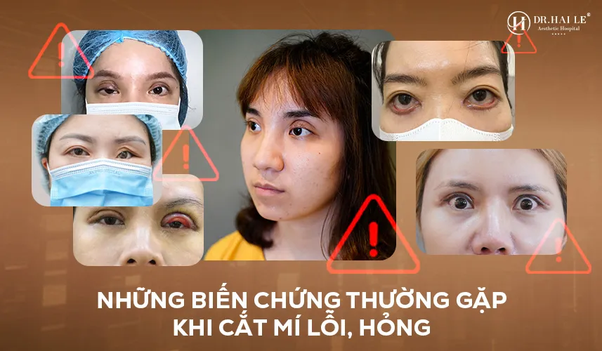 Các dạng biến chứng khi cắt mí lỗi hỏng