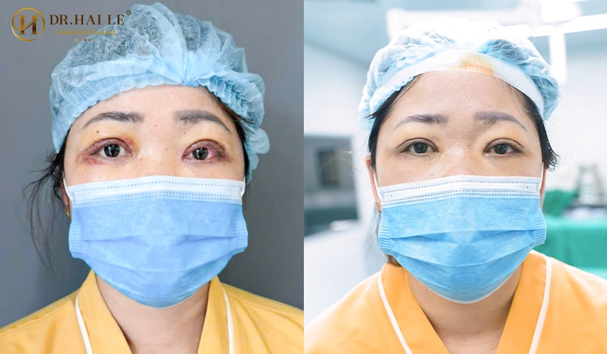 Sửa mí Deep Tech tại Dr.Hải Lê - Tái sinh vẻ đẹp cho cửa sổ tâm hồn 7 Viện Thẩm Mỹ Y Khoa Dr.Hải Lê tự hào là đơn vị được Bộ Y tế cấp giấy phép hoạt động, tiên phong trong sứ mệnh "Giải cứu mọi ca mí lỗi hỏng"