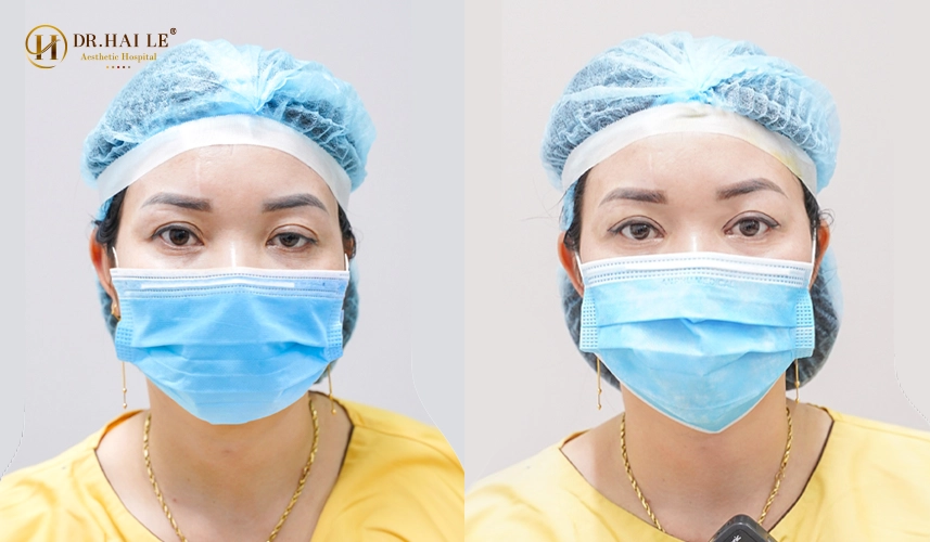 Kết quả sửa mí tại Bệnh viện Tạo hình Thẩm mỹ Dr.Hải Lê