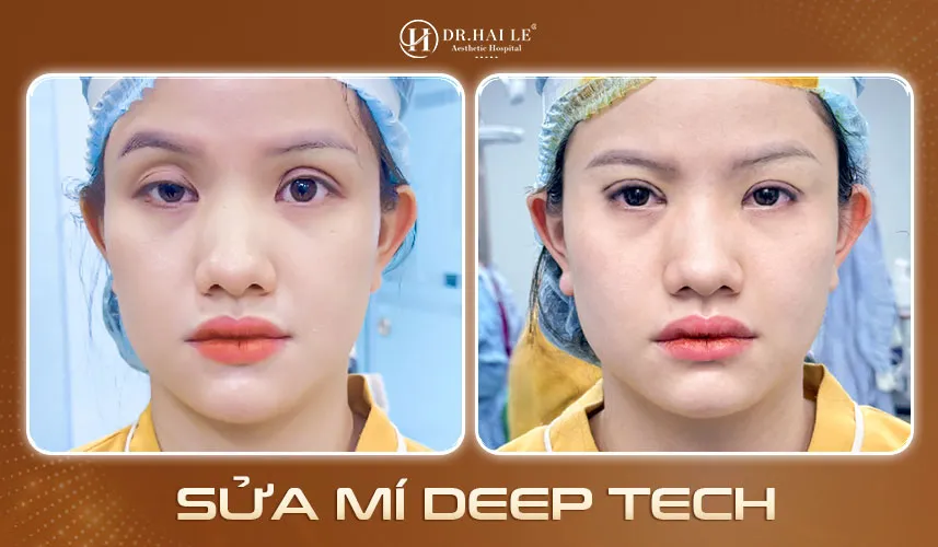 Kết quả khắc phục mí hỏng thực tế tại Dr.Hải Lê