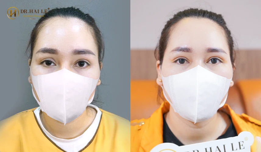 Kết quả sửa mí tại Bệnh viện Tạo hình Thẩm mỹ Dr.Hải Lê