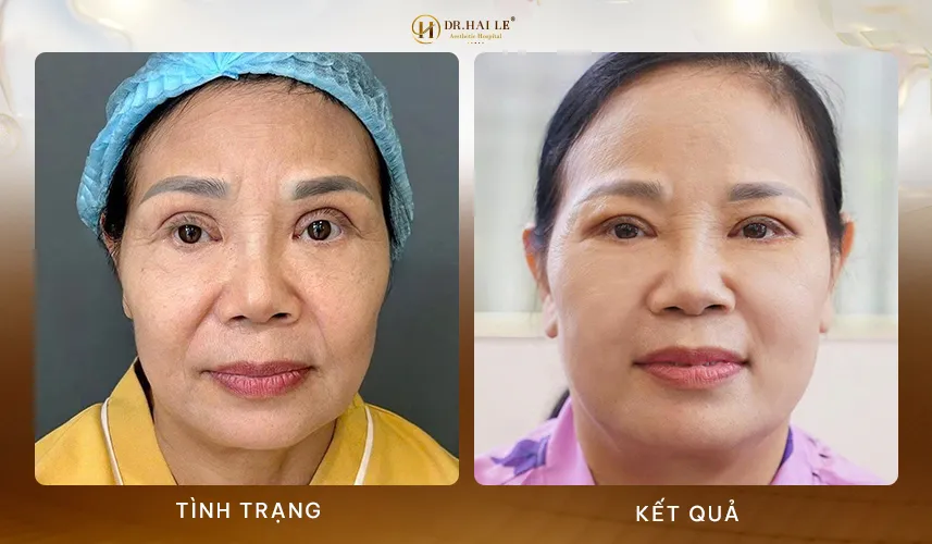 Kết quả sửa mí mắt ấn tượng tại Dr.Hải Lê