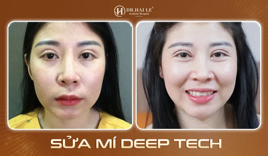 Sửa mí hỏng phức tạp với Deep Tech Med