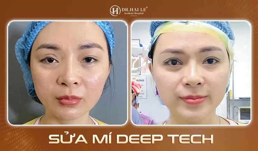 Công nghệ sửa mí Deep Tech tại Dr.Hải Lê