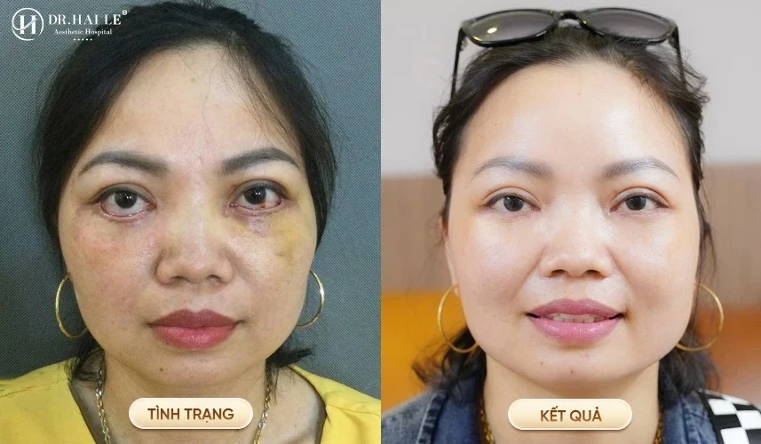 Phẫu thuật sửa mí Deep Tech Repair giúp phục hồi diện mạo và bảo vệ nhãn cầu cho khách hàng bị lật mi.