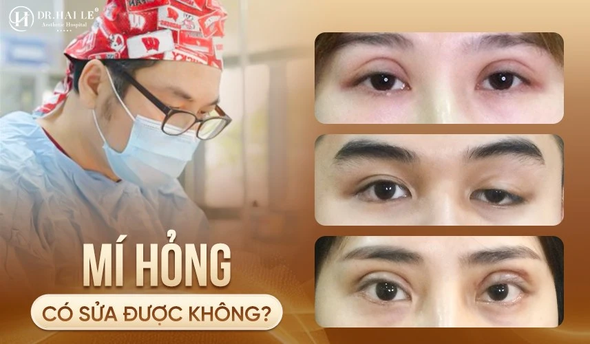 Mí hỏng có sửa được không - Bệnh viện Thẩm mỹ Dr.Hải Lê