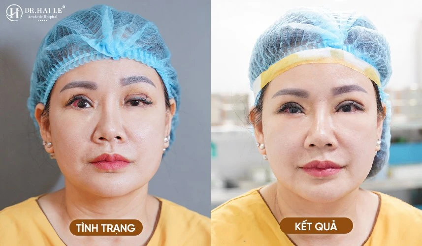 Quy trình sửa mí cắt to chuyên sâu giúp khách hàng lấy lại sự tự tin.