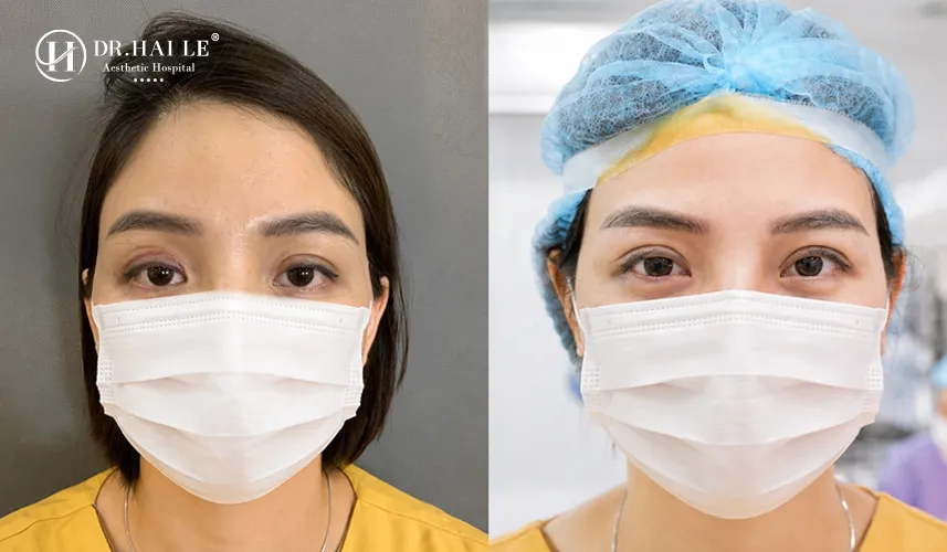 Sự thay đổi ngoạn mục, lấy lại thần thái rạng rỡ của khách hàng sau ca tái phẫu thuật cắt mí bị hỏng thành công xuất sắc tại Dr.Hải Lê.