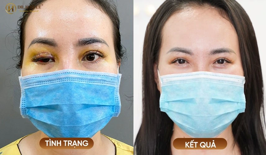 Đôi mắt cân đối, nếp mí rõ ràng tự nhiên là kết quả tuyệt vời sau ca phẫu thuật cắt mí bị hỏng tại Dr.Hải Lê.