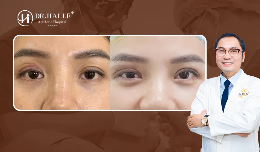 Sửa mí lỗi hỏng uy tín tại Bệnh viện Dr.Hải Lê