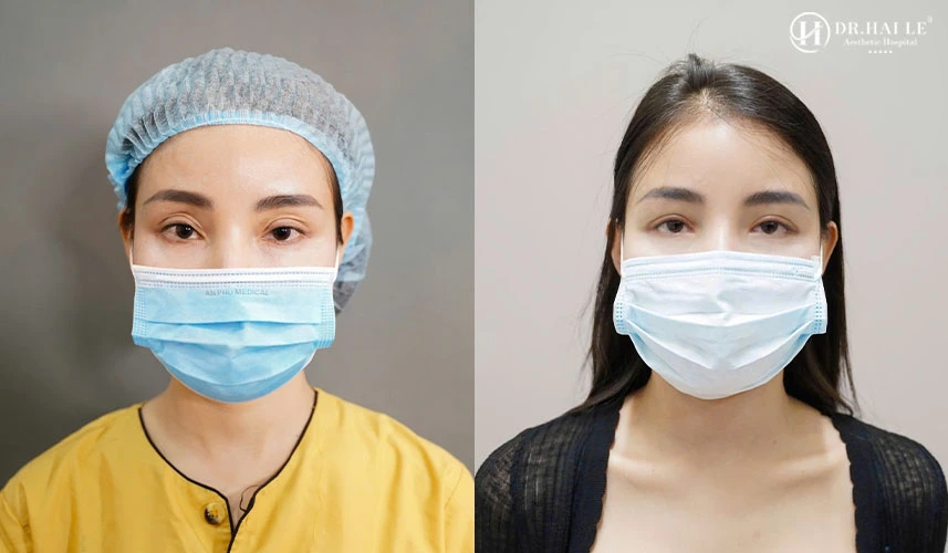 Hình ảnh trước và sau khi xử lý nếp mí nhiều sẹo xơ