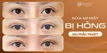 Sửa mí mắt bị hỏng sau phẫu thuật tại thẩm mỹ Dr.Hải Lê?