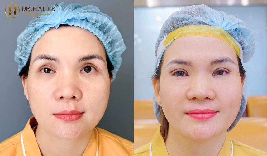 Sửa mí mắt bị hỏng sau phẫu thuật? 3 Sửa mí mắt bị hỏng sau phẫu thuật là một quy trình vi phẫu thẩm mỹ phức tạp nhằm bóc tách toàn bộ các mô xơ sẹo