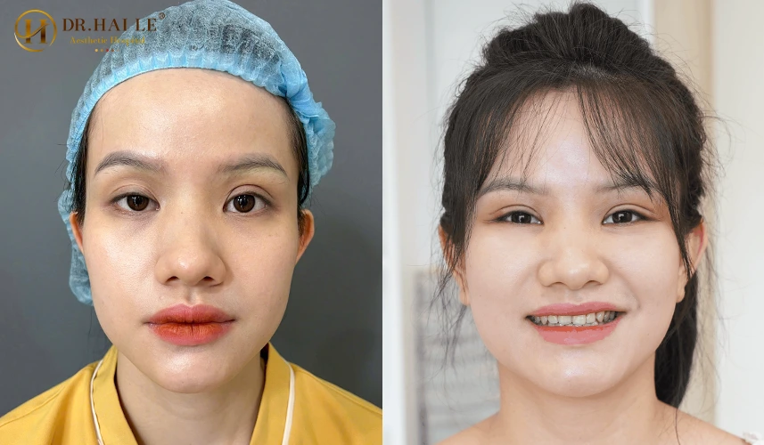 Sửa mí mắt bị hỏng sau phẫu thuật? 5 Trước khi quyết định can thiệp lần hai, bệnh nhân luôn trăn trở vấn đề Phẫu thuật chỉnh sửa mí hỏng ở đâu an toàn?