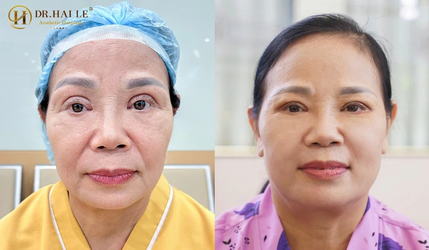 Sửa mí mắt bị hỏng sau phẫu thuật? 7 Chúng tôi cam kết sẽ mang lại sự an toàn tuyệt đối và sự chăm sóc dài lâu trên con đường tìm lại đôi mắt hoàn mỹ của bạn