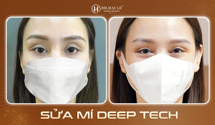 Ứng dụng Deep Tech20 trong sửa mí hỏng