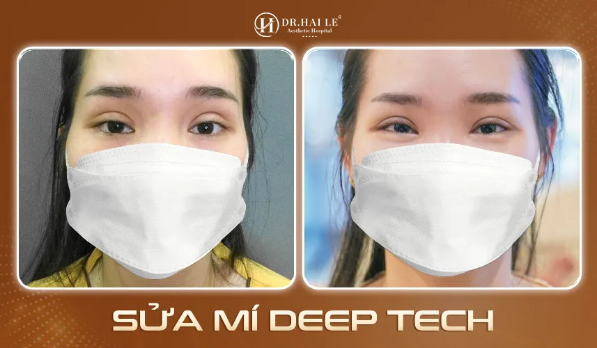 Kết quả sửa mí tại Bệnh viện Tạo hình Thẩm mỹ Dr.Hải Lê 3