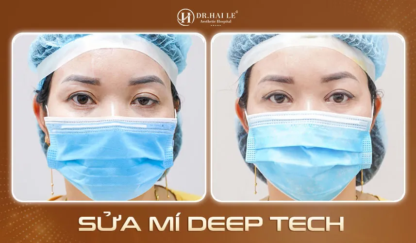 Kết quả sửa mí tại Bệnh viện Tạo hình Thẩm mỹ Dr.Hải Lê