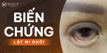 Sửa mí mắt dưới không đẹp phải làm thế nào?