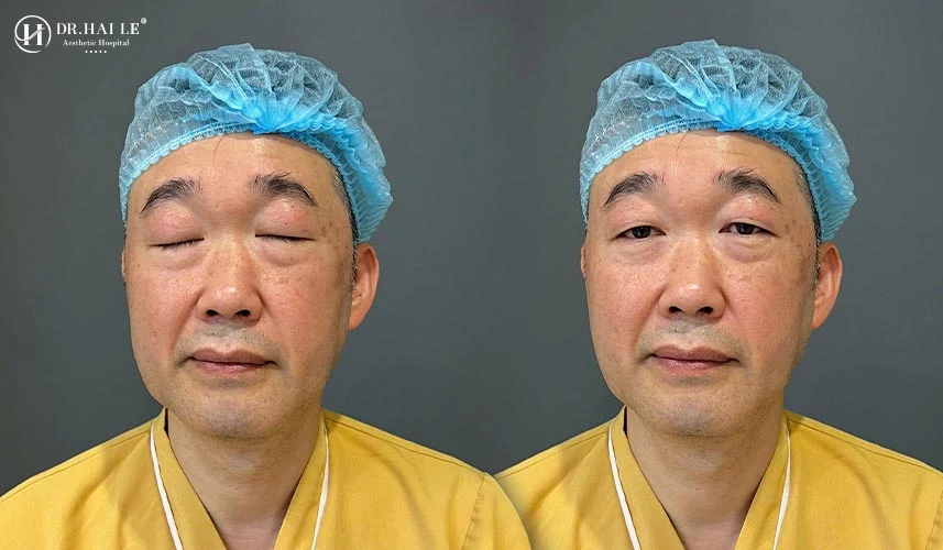 Sửa mí mắt dưới không đẹp (hoặc phẫu thuật tái tạo mí dưới bị hỏng) là một kỹ thuật chỉnh hình vi phẫu chuyên sâu nhằm khắc phục các hậu quả